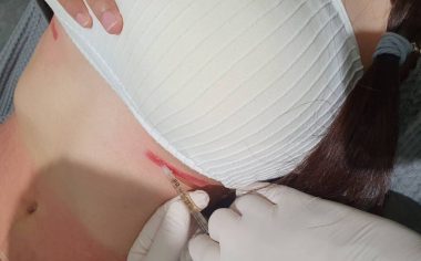 Dr Tattof Bangkok Dermatologists Use Patients Own Blood Cells to Accelerate Laser Scar - TRAVELINDEX